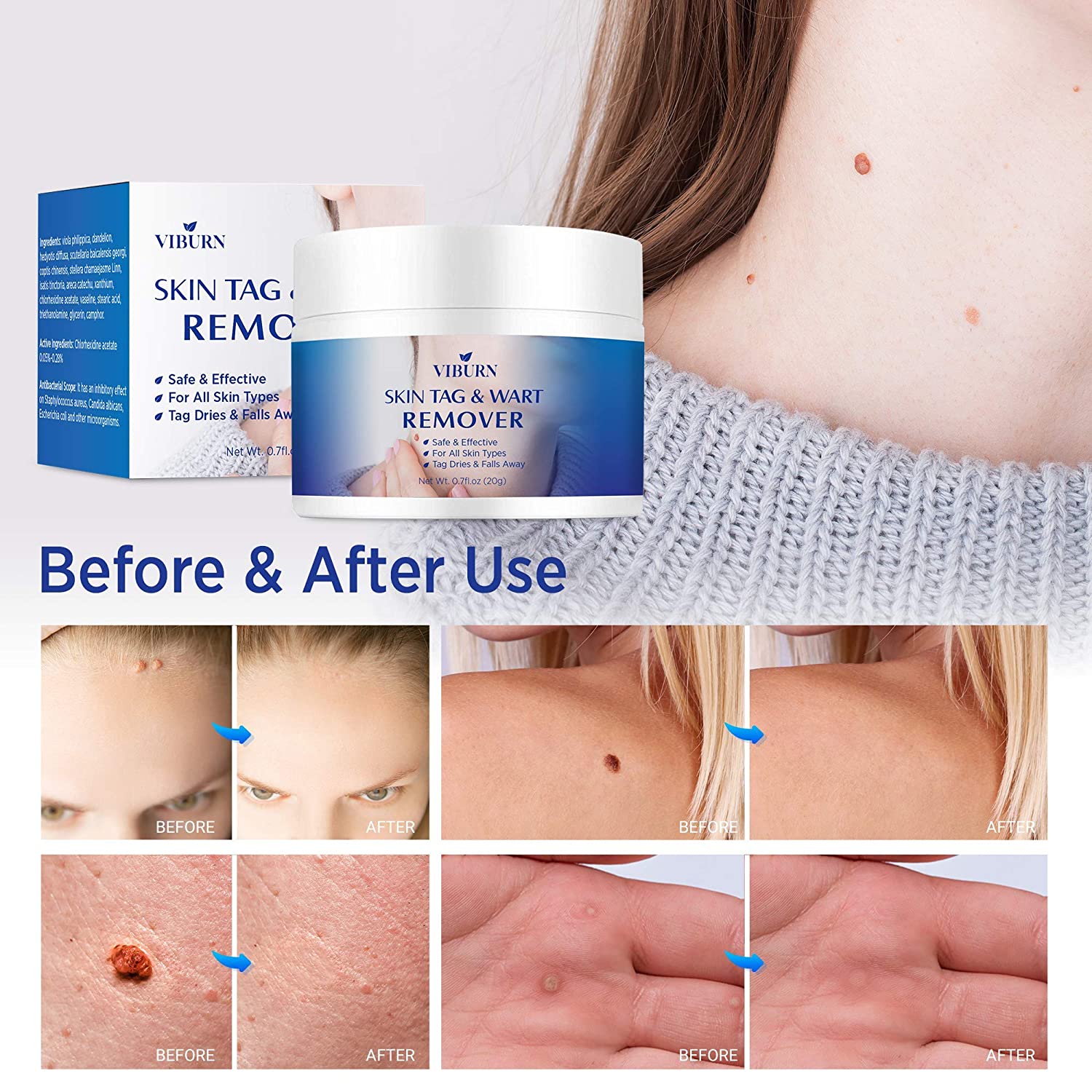 best skin tag remover for sensitive areas